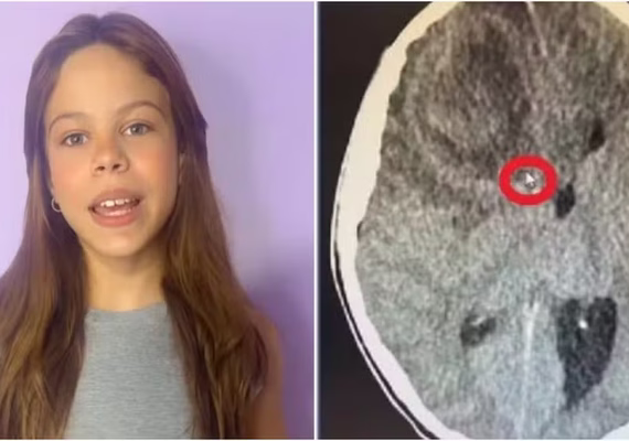 Caso Millena Brandão: laudo aponta infecção no cérebro como causa da morte da atriz mirim