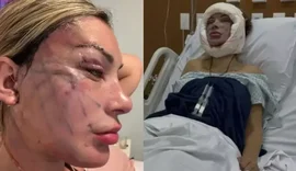 23 outra vez? Médicos reagem após Andressa Urach realizar cirurgia de rejuvenescimento