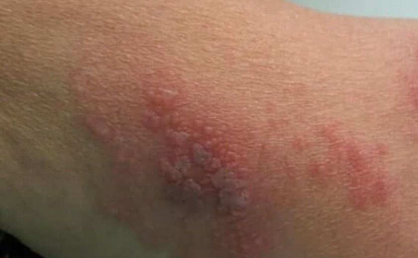 O avanço da Herpes