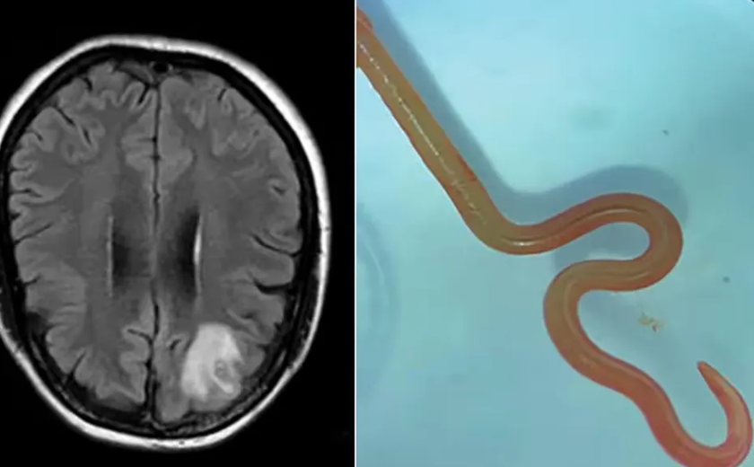 Verme de 8 centímetros parasita de cobra píton é encontrado em cérebro de mulher de 64 anos