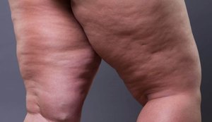 Lipedema: o que é a doença frequentemente confundida com obesidade e celulite