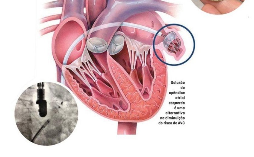 Cardiologia da Santa Casa de Maceió inova com próteses que podem evitar AVC