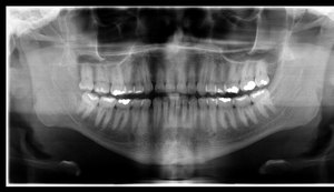 Corpo de enfermeiro do Mato Grosso é identificado após exame de odontologia legal