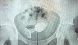 Paciente é internada após uso de plug anal: o que é e como evitar problemas?