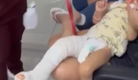 Criança de dois anos recebe alta após fratura no fêmur e família denuncia falha em atendimento médico