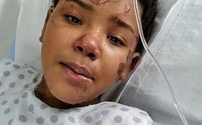 Morre garota queimada por explosão de celular