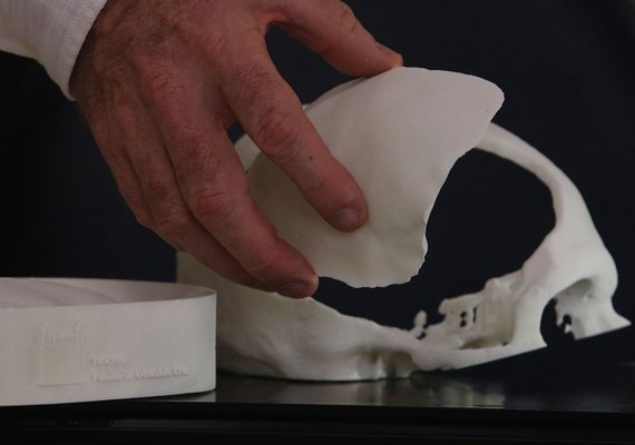 Pesquisadores brasileiros desenvolvem tecnologia de reconstrução craniana