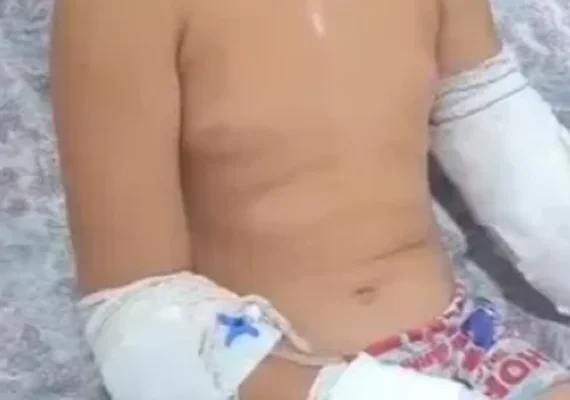 Criança de 10 anos  perde parte do braço após grave colisão entre ambulância e ônibus em Maribondo