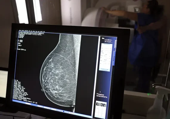 Cerca de 77 mil mulheres aguardam mamografia pelo SUS
