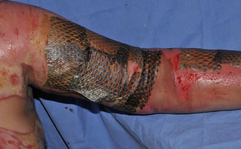 Médicos usam pele do peixe tilápia para tratar queimaduras