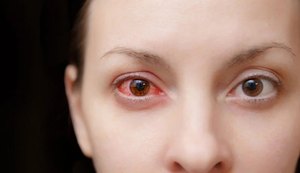 Conjuntivite: oftalmologista orienta sobre prevenção e quando buscar atendimento