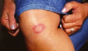 Dia Internacional do Hanseniano: tratamento completo é caminho para erradicação da doença