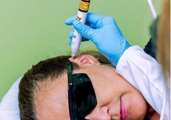 Em Maceió, acupuntura a laser promete tratamento indolor com resultados inéditos