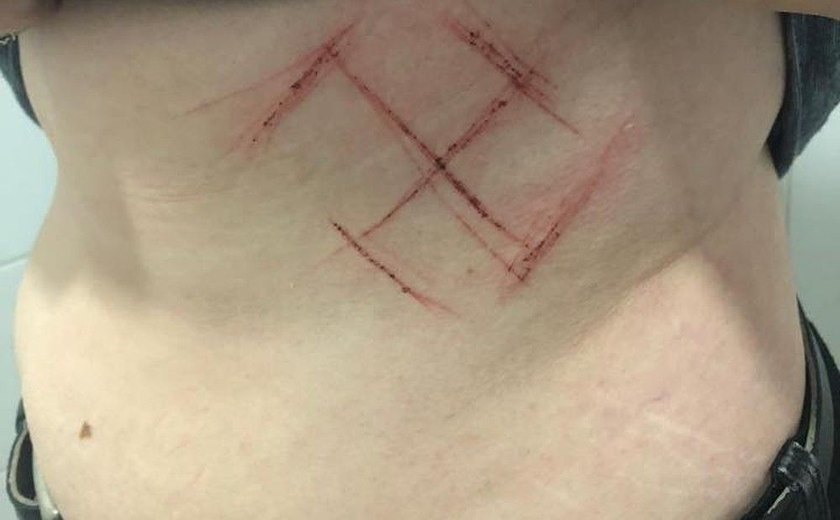 Jovem é ferida com canivete por usar camisa com 'ele não'; suástica foi marcada na pele