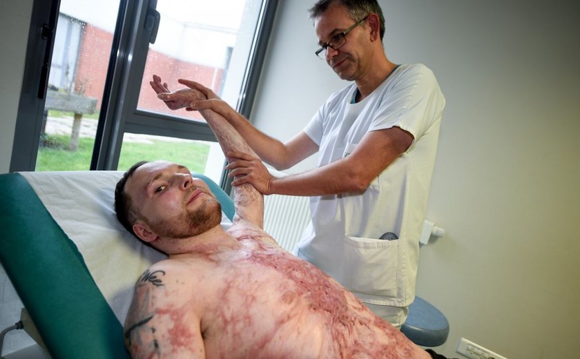 Homem de 33 anos sobrevive na França graças a transplante de pele do irmão gêmeo