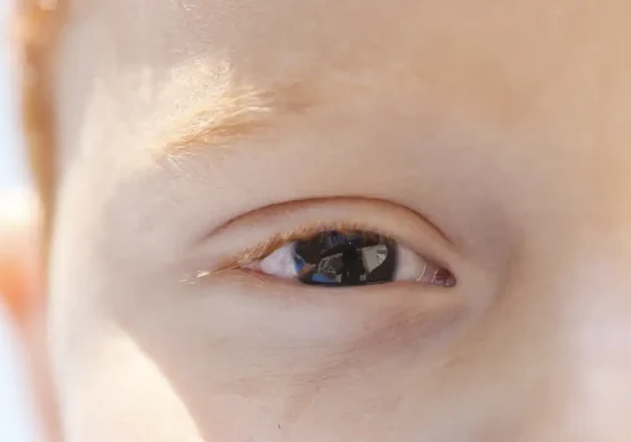 Erros de refração são principal causa de deficiência visual infantil