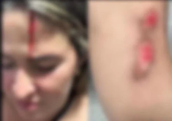 Olivença: mulher sobrevive a tentativa de feminicídio após ser atropelada e agredida pelo ex-companheiro