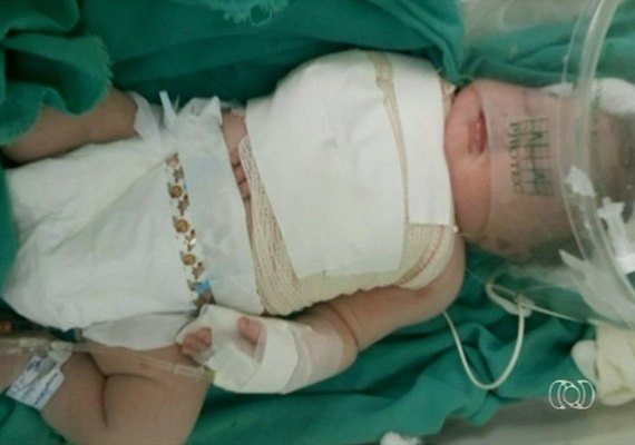 Bebê tem braço e clavícula quebrados durante parto em hospital público