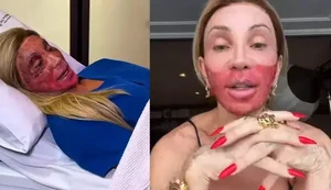 Maya Massafera deixa rosto em carne viva e motivo vem à tona