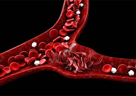 Associação promove conscientização sobre a Doença Falciforme