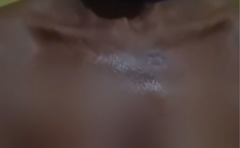 Mulher é queimada com óleo quente pelo companheiro em Mata Grande