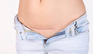 Cesárea aumenta risco de câncer de placenta após mola gestacional