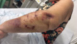 Turista de 70 anos é atacada por três cães e sofre ferimentos graves em Paripueira