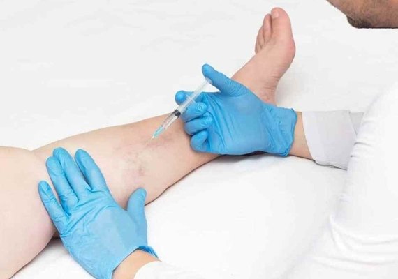 Saúde disponibiliza tratamento de microvasos e varizes no Pam Salgadinho