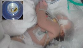 Bebê é picada cinco vezes por escorpião; animal foi encontrado no cordão umbilical