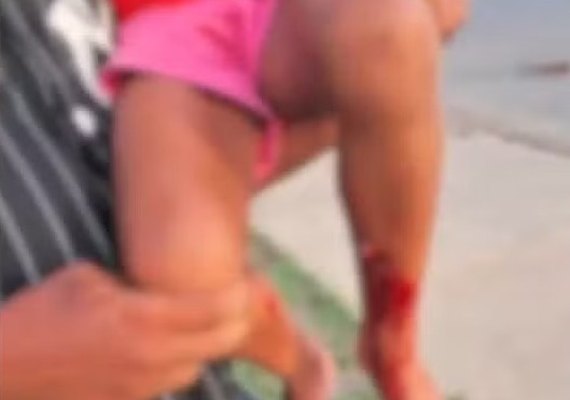 Menina é atacada por pitbull e chega a urinar de medo em condomínio; tutor foi preso